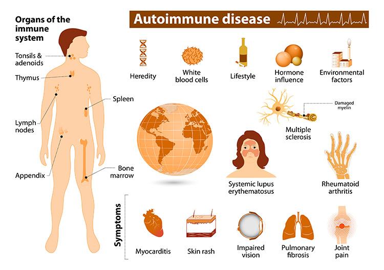 Autoimmune Disease: Symptoms and Treatment