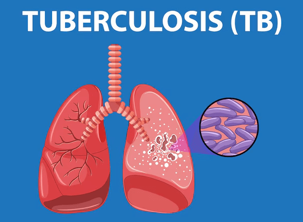 Pulmonary Tuberculosis (TB)
