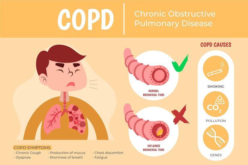 COPD: Symptoms and Treatment
